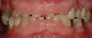 Severely Worn Front Teeth