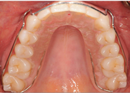 Kois Deprogrammer in the Mouth 2