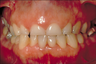 Worn teeth from grinding