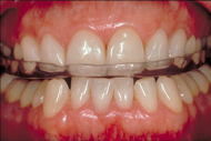 Night guard to protect the teeth