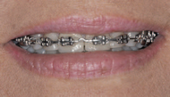 Metal Brackets
