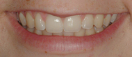 Before whitening