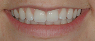 After whitening