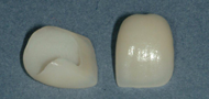 Thinnest porcelain restorations