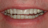 Improve color and shape of teeth