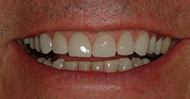 Close spaces between teeth