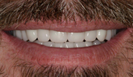 Restores smile and function 1