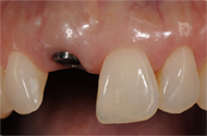 Dental Implant in the Mouth