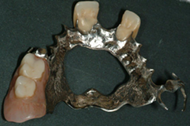 Removable Partial Denture replacing upper teeth 1