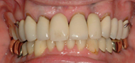 Removable Partial Denture replacing upper teeth 3