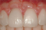 After Implant & Crown Placement