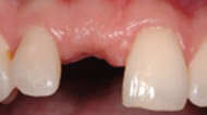 After Bone Graft