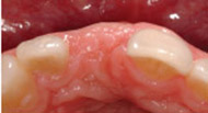 After Bone Graft