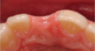 Before Bone Graft