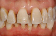 After non-surgical periodontal therapy