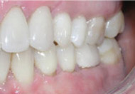 After Gum Grafting