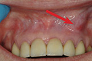 Dental Abcess
