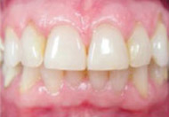 Mild Periodontal Disease