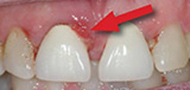 Before Surgical Periodontal Therapy