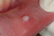 'Fibroma' from Cheek Biting