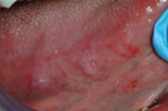 Oral Cancer on the side of the tongue