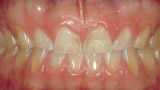 Front surface abrasion