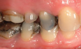 Decay Under Old Fillings