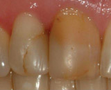Leakage Around Edge of White Filling