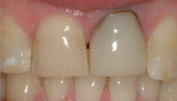Dark Tooth from Root Canal Treatment