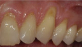 Gum Recession Exposing Darker Root