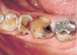 Total loss of biting surface of back teeth