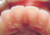 Thinning of inside surface of upper front teeth