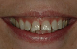 Flared tooth