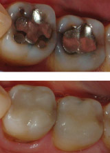 Replace silver fillings