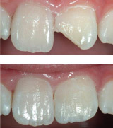 Improve the shape of teeth