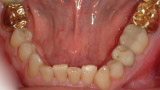 Gold crowns build back function