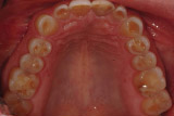 Erosion from Acid Reflux